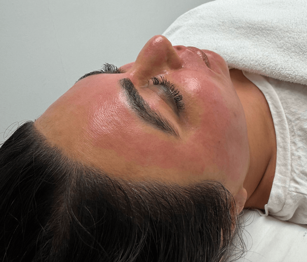 Person relaxing after micro needling treatment at Zohreh Spa